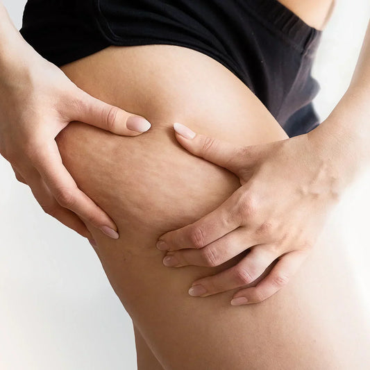 HOW TO IMPROVE BLOOD CIRCULATION TO REDUCE CELLULITE